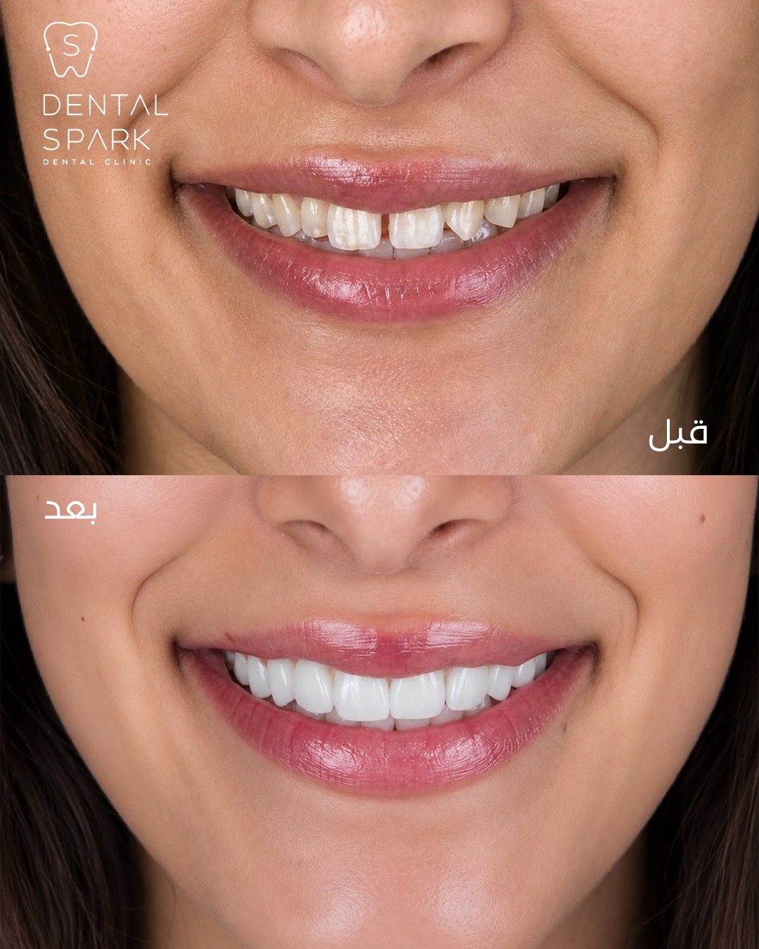 Before and After 4